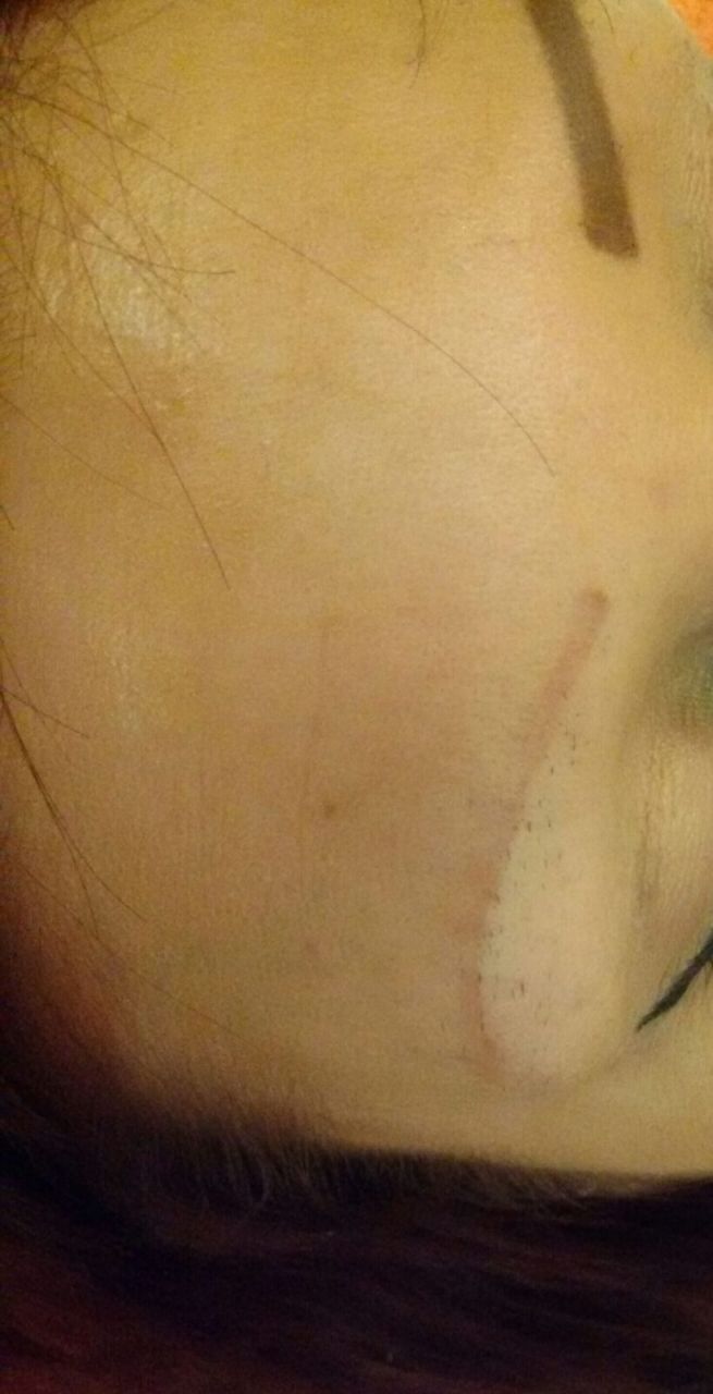 Dermway I Q-kapcsolt Nd YAG, Körömgomba és Tetoválás eltávolító lézer Dermway I Q-kapcsolt Nd YAG, Körömgomba és Tetoválás eltávolító lézer