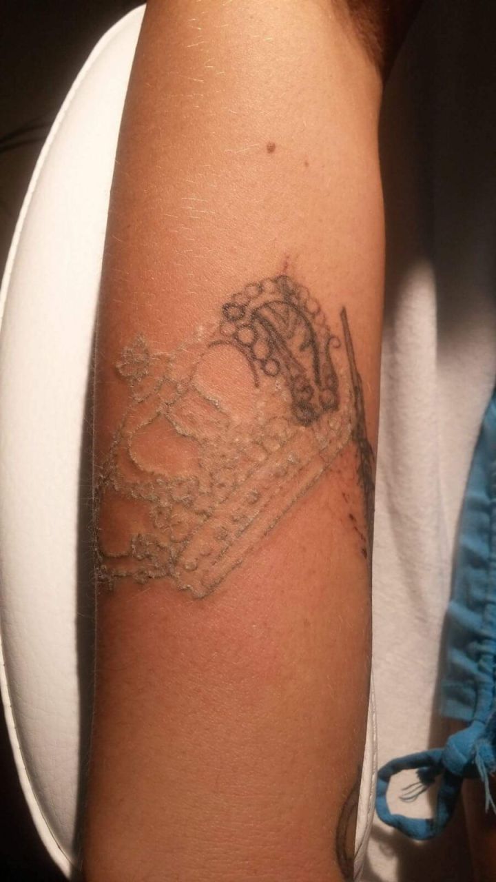 Dermway I Q-kapcsolt Nd YAG, Körömgomba és Tetoválás eltávolító lézer Dermway I Q-kapcsolt Nd YAG, Körömgomba és Tetoválás eltávolító lézer