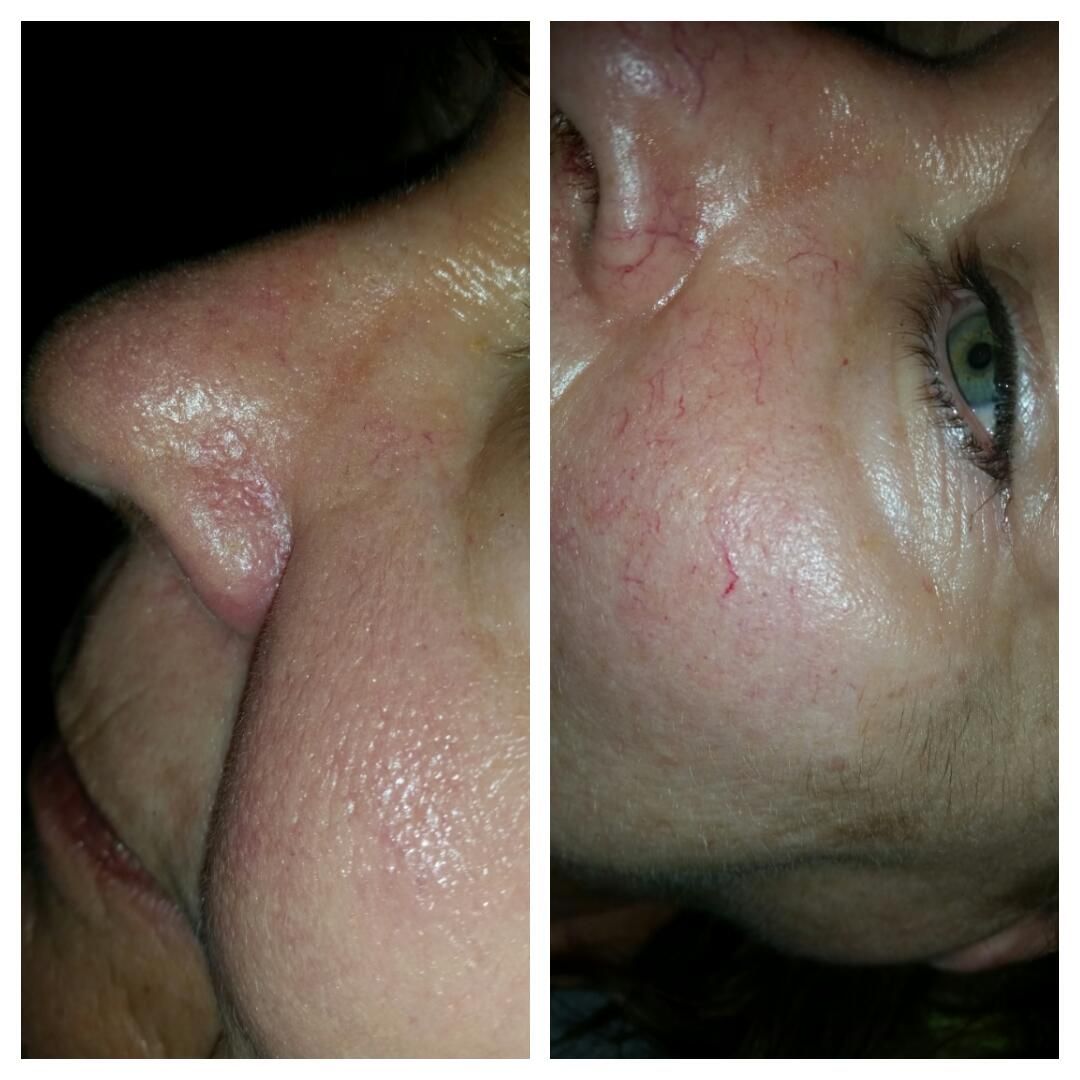 VEINSTAR Thermokoagulációs értágulat, hajszálérkezelő Kozmetikai gép VEINSTAR Thermokoagulációs értágulat, hajszálérkezelő Kozmetikai gép