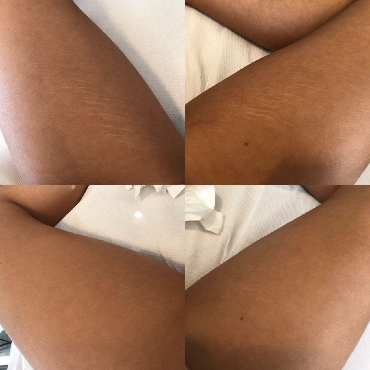 Mesolux™ FOTO-ELEKTROPORACIÓ Mezoterápiás gép