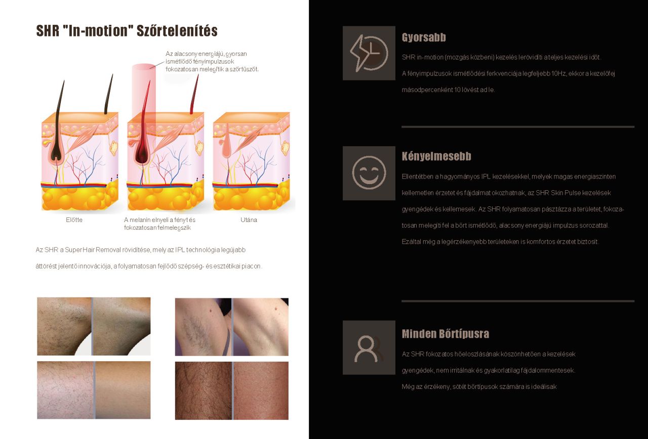 Dermalux II -SHR-IPL Szőrtelenítő gép E-Light funkcióval Dermalux II -SHR-IPL Szőrtelenítő gép E-Light funkcióval