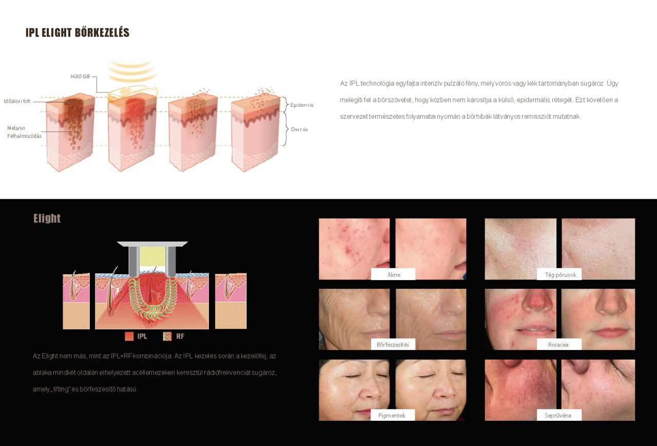 Dermalux II -SHR-IPL Szőrtelenítő gép E-Light funkcióval Dermalux II -SHR-IPL Szőrtelenítő gép E-Light funkcióval