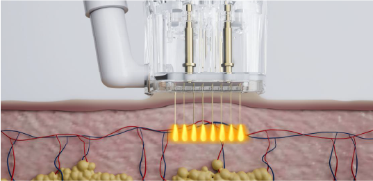 Microderma Pro- Frakcionált Mikrotűs Rádiófrekvencia Arckezelő gép Microderma Pro- Frakcionált Mikrotűs Rádiófrekvencia Arckezelő gép